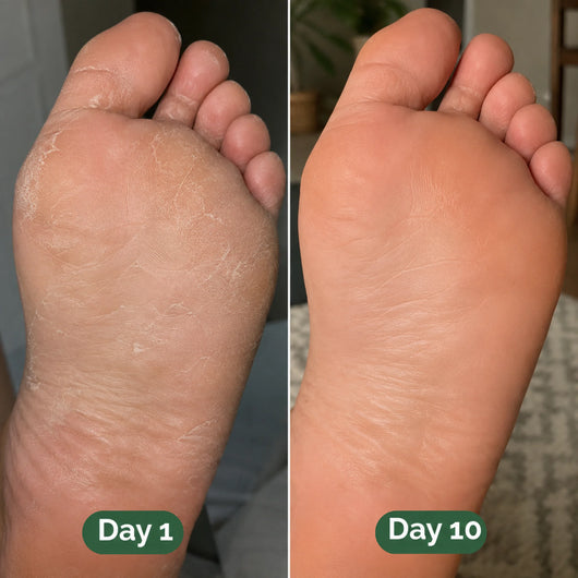 MIRA Antifungal Soap®
