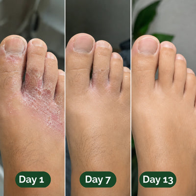 MIRA Antifungal Soap®