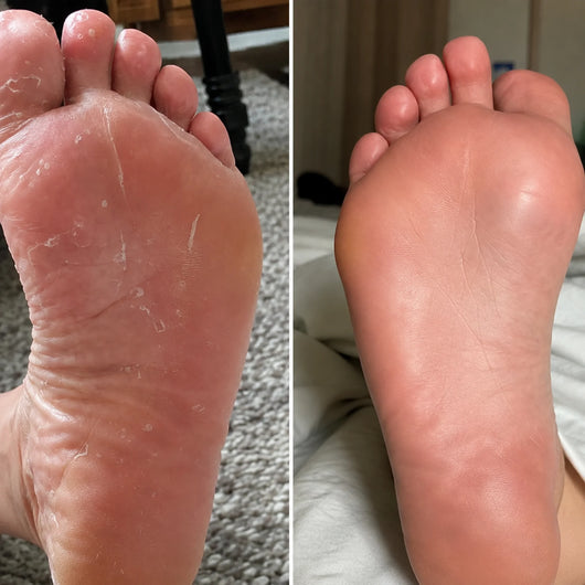 MIRA Antifungal Soap®