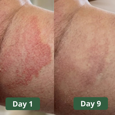 Mira Antifungal Soap