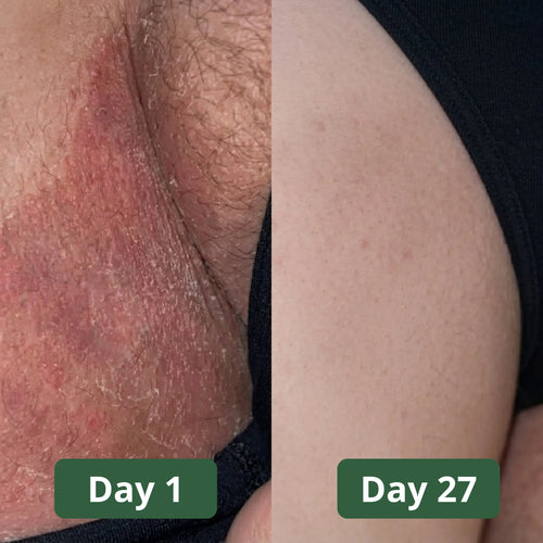 Mira Antifungal Soap