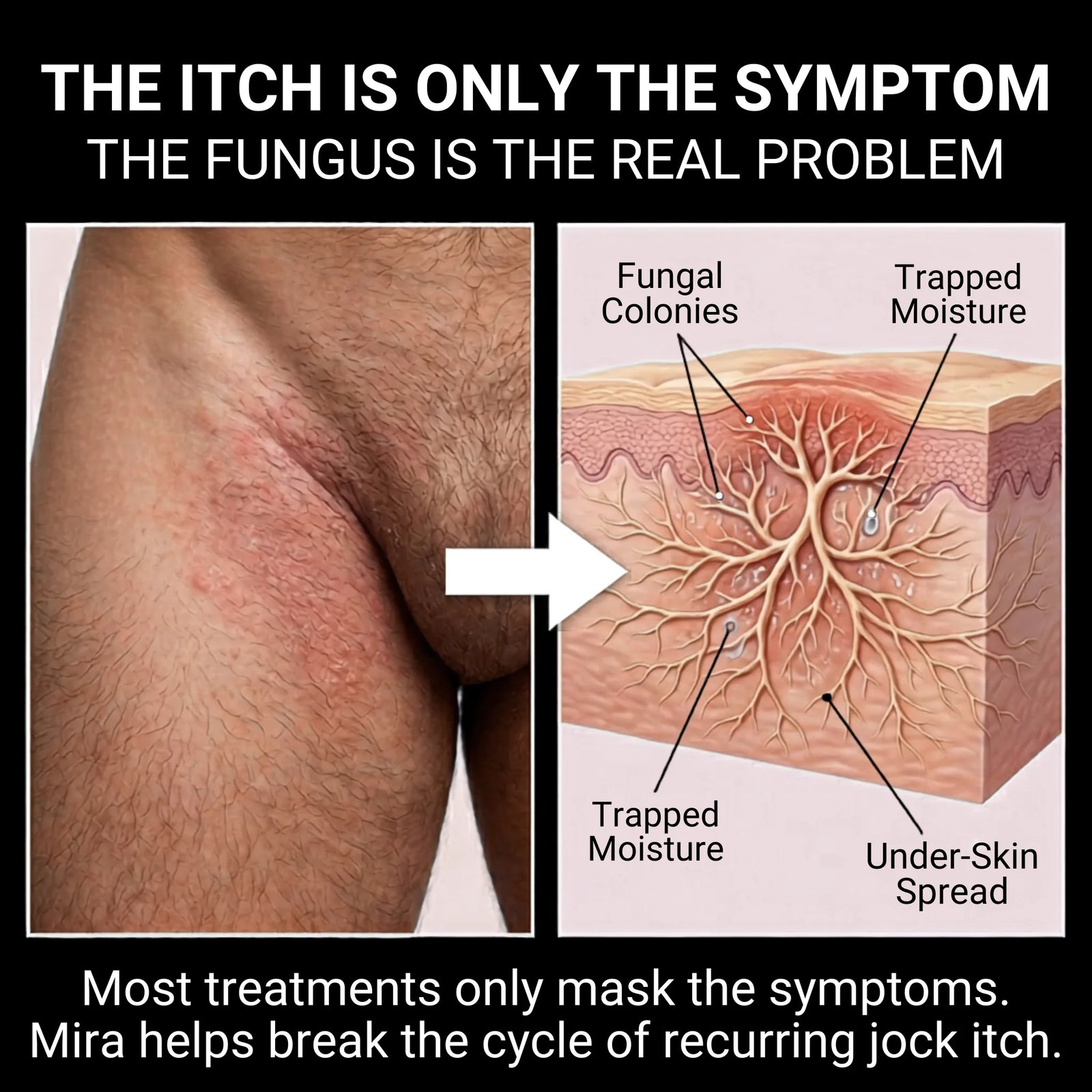 Your Jock Itch Will Keep Coming Back Unless You Fix This.
